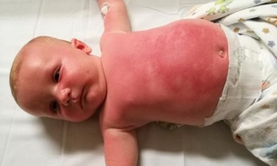 Bebê de 3 meses passa mal após usar filtro solar da Peppa Pig  