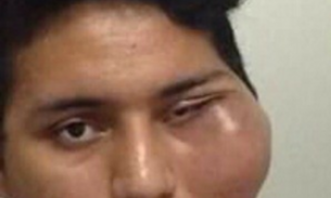 Após extrair dente, jovem fica com rosto deformado há quase 1 ano 