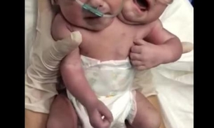 Bebê com duas cabeças nasce no México 