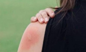 Saiba como se proteger das picadas de insetos de forma natural