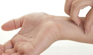 Saiba como tratar impinges e feridas na pele de forma natural  