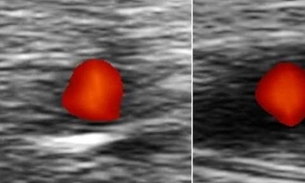 Como identificar sintomas da doença que causa cegueira repentina
