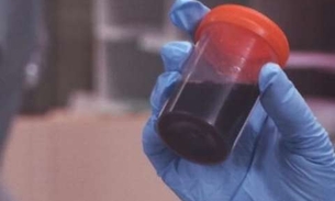 Pesquisadores descobrem a causa da doença da urina preta 