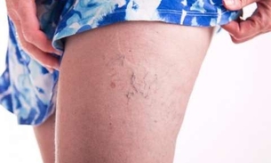 Cipó tem efeitos positivos contra hemorróidas e varizes