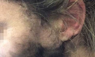 Mulher tem rosto queimado por fone de ouvido durante voo