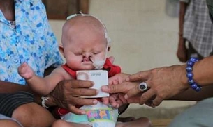 Bebê 'sereia': Imagem impressionante mostra criança que sofre com doença rara