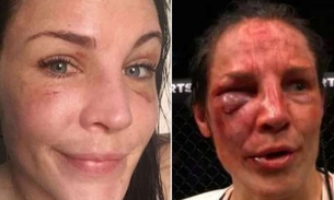 Após ficar desfigurada em combate, lutadora do UFC mostra recuperação