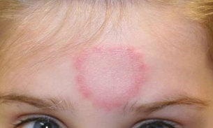 Conheça planta que combate impingem e feridas causadas por inseto 