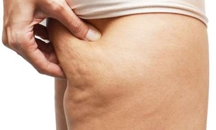 Com propriedades medicinais, planta ajuda a combater celulites