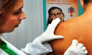 Fundação Alfredo da Matta realiza mutirão dermatológico em Manaus