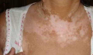 Em poucos dias a cura definitiva do vitiligo com apenas um ingrediente