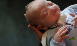 Bebê nasce com doença rara e detalhe no rosto intriga médicos