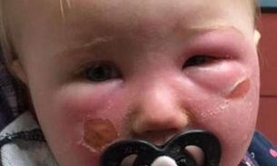 Protetor solar infantil causa queimaduras graves no rosto de bebê de um ano
