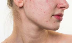 Babosa e Limão podem combater acnes e espinhas 