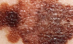 Cientistas identificam proteína que controla metástase do câncer 