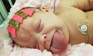 Bebê quase morre sufocado com a própria língua passa por cirurgia