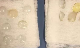 Médicos encontram 27 lentes de contato em olho de paciente 