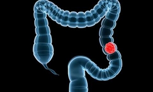 Saiba como  prevenir pólipos intestinais e o câncer 