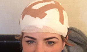 Mulher perde parte do couro cabeludo na tentativa de ficar na moda