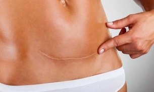 Mulheres que fazem cesárea têm dobro de chance de desenvolver dor durante o sexo, diz estudo