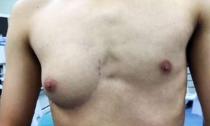 Homem passa por mastectomia após desenvolver seio 