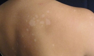 Tintura de planta é indicada para tratar impingem e pano-branco no rosto. Conheça   