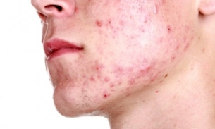 Gel feito de óleo de peixe trata espinhas, micoses, inflamações e abscessos. Conheça 