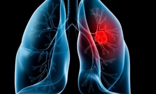 Conheça vegetal aliado na prevenção e combate ao câncer de pulmão 