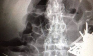 Cirurgiões retiram mais de cem peças de metal do estômago de paciente