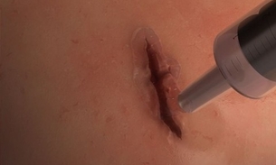 Nova cola cirúrgica promete fechar ferimentos em segundos