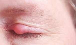 Semente de fruta pode combater terçol. Conheça 