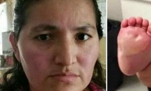 Babá se irrita com bebê de 6 meses e queima seus pés em frigideira quente