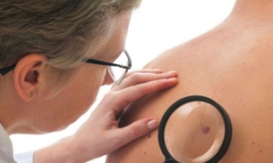 Mutirão oferece 700 consultas dermatológicas gratuitas em Manaus