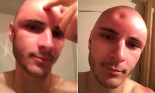 Jovem choca com testa amassada e foto viraliza na web