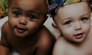 Primeiras gêmeas do mundo com cores de pele diferentes já são adultas; Veja
