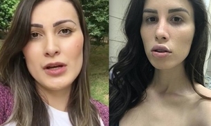 Irreconhecível, youtuber que sofreu infecção por silicone recebe ligação de Andressa Urach