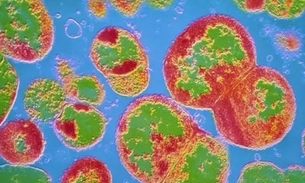 Supergonorreia resistente a antibióticos tem primeiro caso confirmado