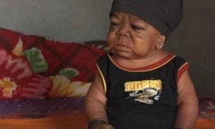 Jovem de 23 anos com doença rara é rejeitado pelo pais por ter tamanho de bebê