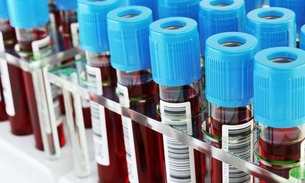 Exame de sangue permite diagnóstico precoce do autismo  
