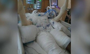 Menina de 12 anos tem 49% do corpo queimado após cumprir 'desafio do fogo'