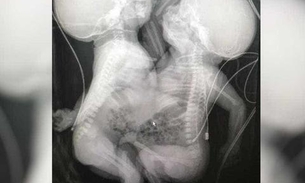 Recém-nascidas, siamesas separadas em Goiânia estão em estado gravíssimo