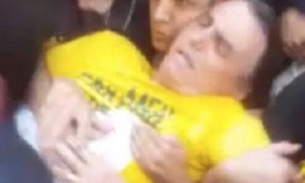Foto mostra abdômen de Bolsonaro cortado de ponta a ponta após cirurgia