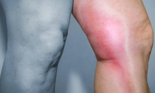 Voos longos podem provocar trombose e até embolia pulmonar