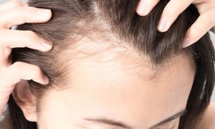 Mitos e verdades sobre a queda de cabelo e calvice precoce 