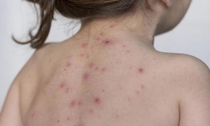 Brasil perderá status de país livre do sarampo após caso endêmico no Pará