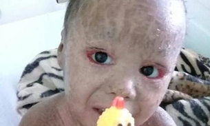 Em Manaus, família pede doações para menino com doença rara 