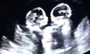  Gêmeas são flagradas 'brigando' dentro do útero em ultrassom; Veja vídeo 