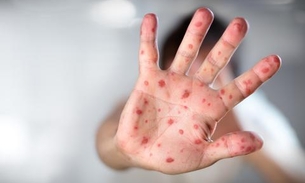 Casos de sarampo têm aumento de 300% no mundo, diz OMS