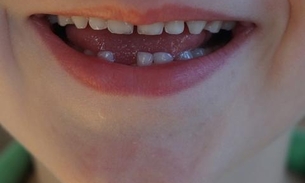 Campanha na internet incentiva doação de dentes de leite 