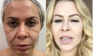 Médico mostra antes e depois da harmonização facial de Joelma